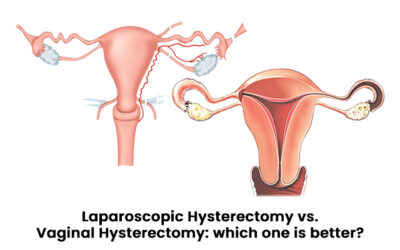 Laparoscopic Hysterectomy vs. Vaginal Hysterectomy: which one is better?