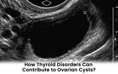 How Thyroid Disorders Can Contribute to Ovarian Cysts?